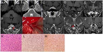Endoscopic endonasal transsphenoidal surgery for unusual sellar lesions: eight cases and review of the literature